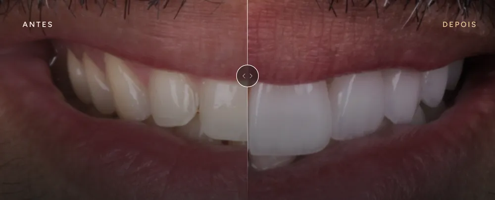 Antes e depois de um caso do Dr. Igor, mesma vista